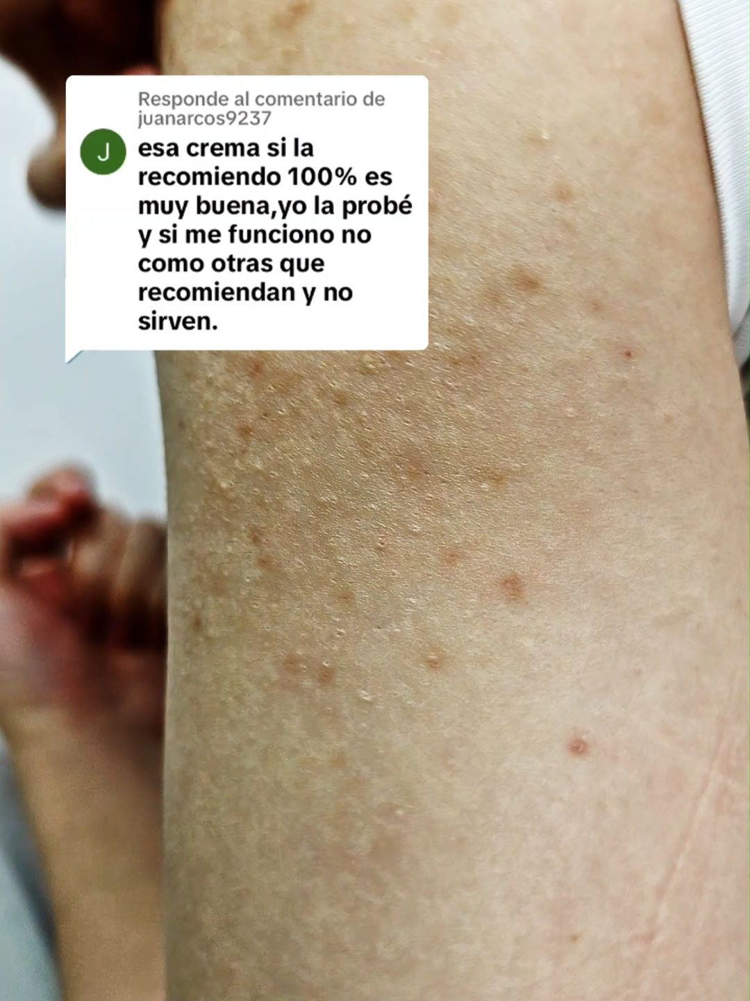 Dile adiós a las imperfecciones en los brazos y luce una piel más limpia y suave #piellimpia #imperfecciones #skincare #rutinasaludable #confidenceboost #00