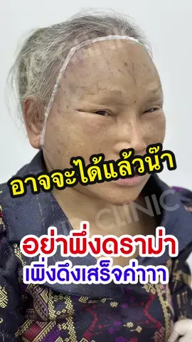 มาจ๊ะ มาดูกันเลยค่ะ งดดราม่าเด้อ #ดึงหน้าudclinic #udclinic #ดึงหน้าชั้นลึก #ดึงหน้าขอนแก่น #ดึงหน้าย้อนวัย 