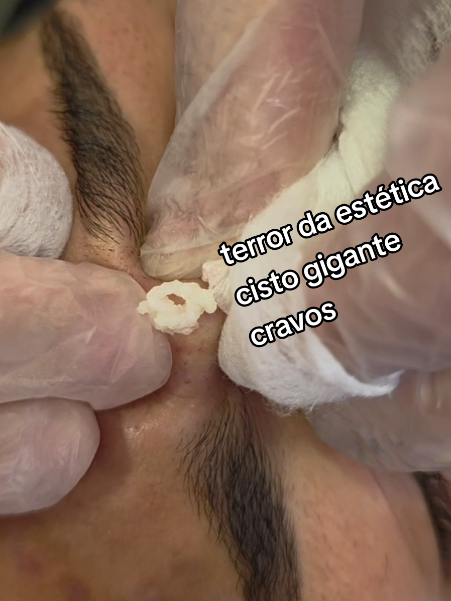 limpeza de pele tratamento de acne #acne #cyst #tiktok #viral #fyp 