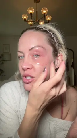 #undereyebags #undereyecircles #undereyes 