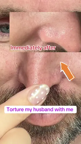 I cannot believe how much came out of his nose! 🤢 #drmelaxinpeelshot #blackheadextractor #largepores #cloggedpores #tiktokshopcreatorpicks 