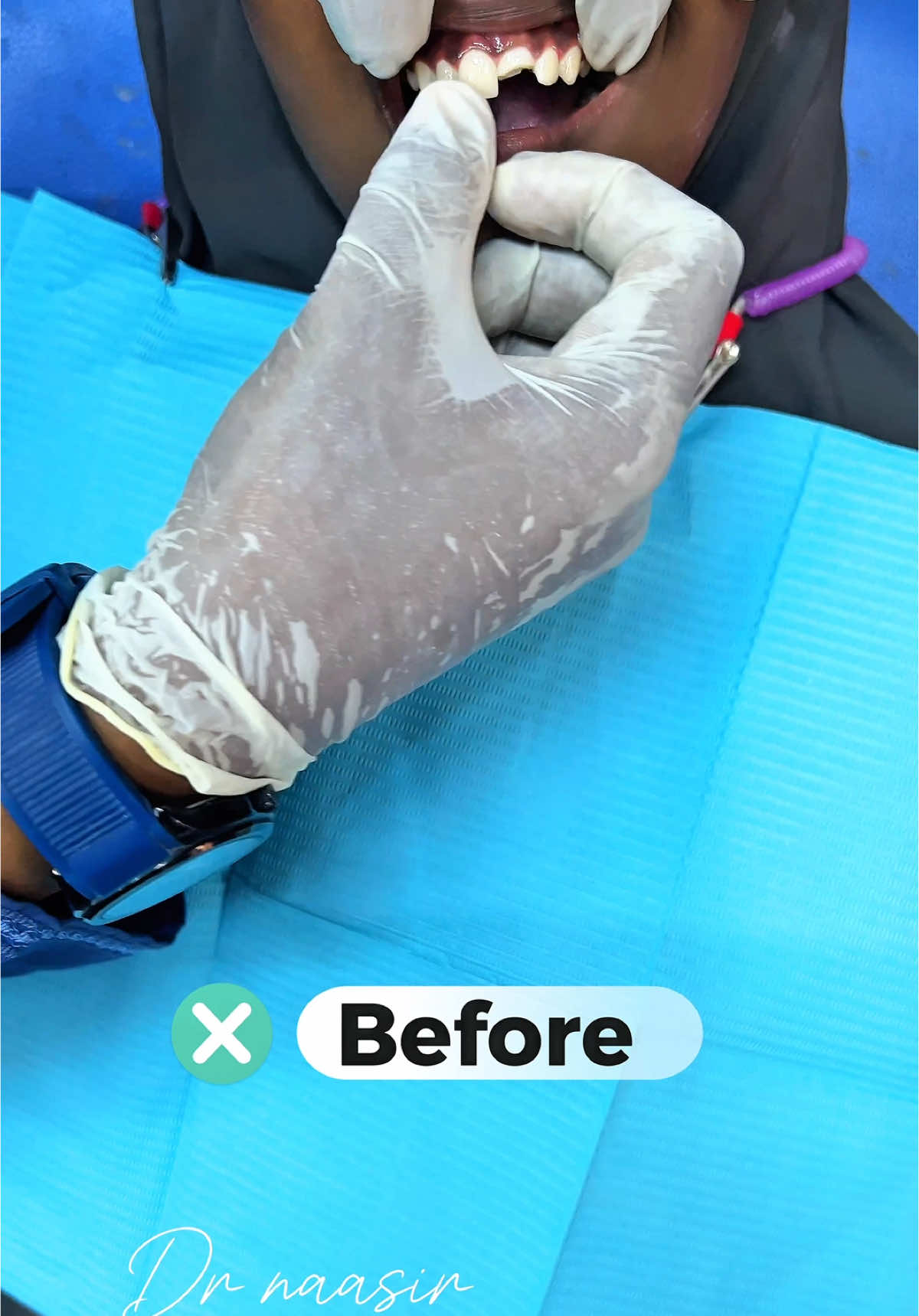 📍Filling Front tooth 💙🤍🩺 #dentist #ilkaha #somalidentist #muqdisho #viral #somalitiktok #kakaaftooncabashada🇸🇴🦷🇲🇾 