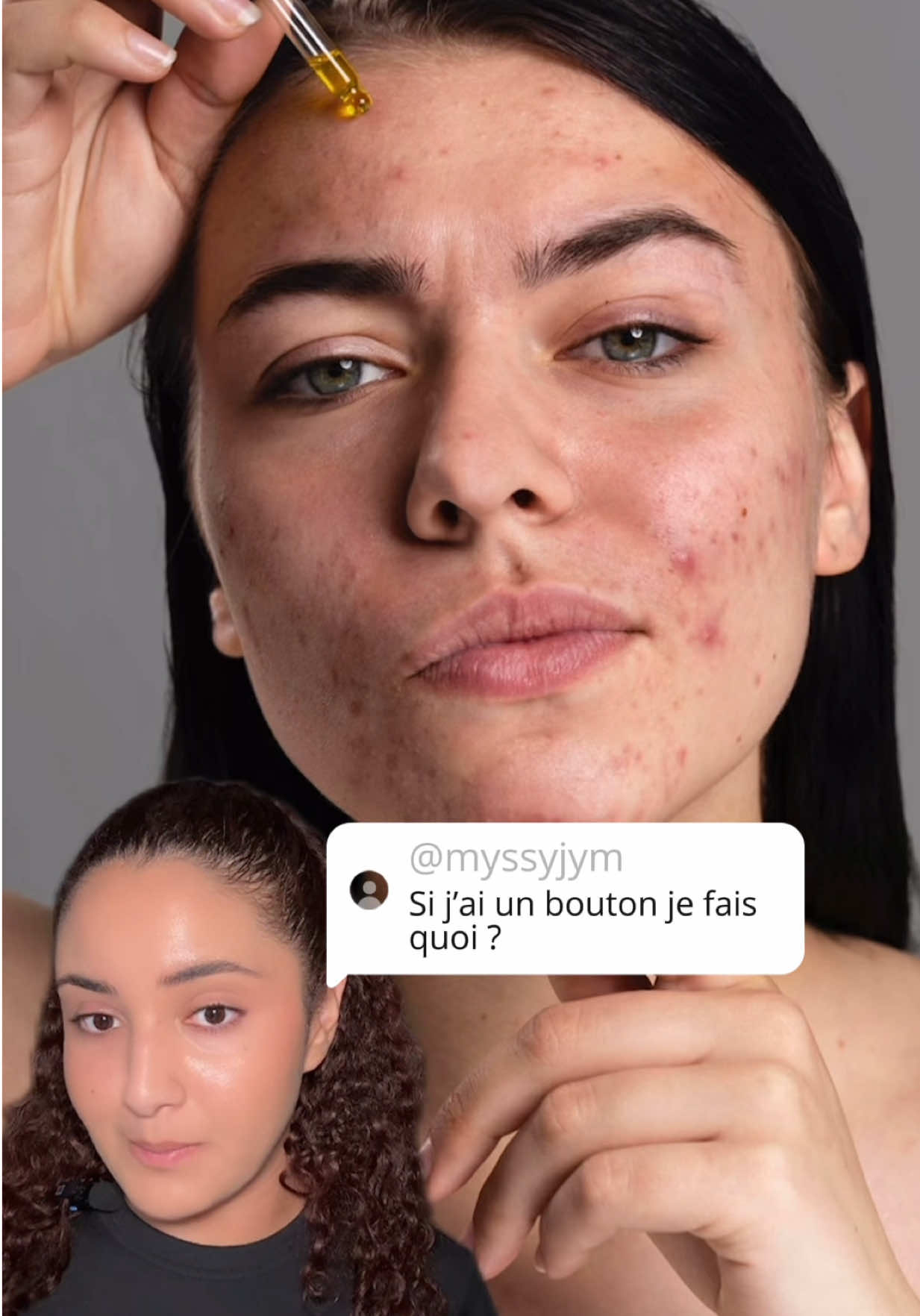 Publicité @La Roche-Posay @CeraVe | Question pour un champion : je fais quoi si j'ai un bouton ? Des nouveaux patchs sont disponibles chez Cerave et La Roche Posay ! Ils ont tous les deux sa spécificité et vont t’aider à diminuer ton bouton. Lequel tu choisirais ? #skincare #patchsboutons #cerave #larocheposay #soindelapeau 