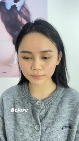 Before and after luxury face filler #malaysiachinese #malaysia #malaysiagirl #kualalumpurmalaysia #malayalamcomedy 