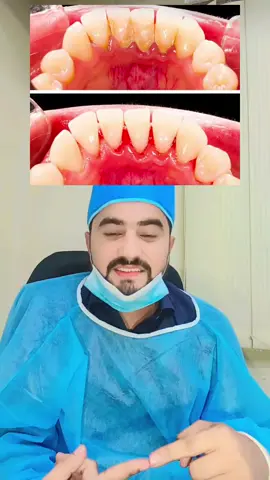 #creatorsearchinsights #scalingteeth🦷 #teethcleaning #teethwhitening #foryoupageofficiall 