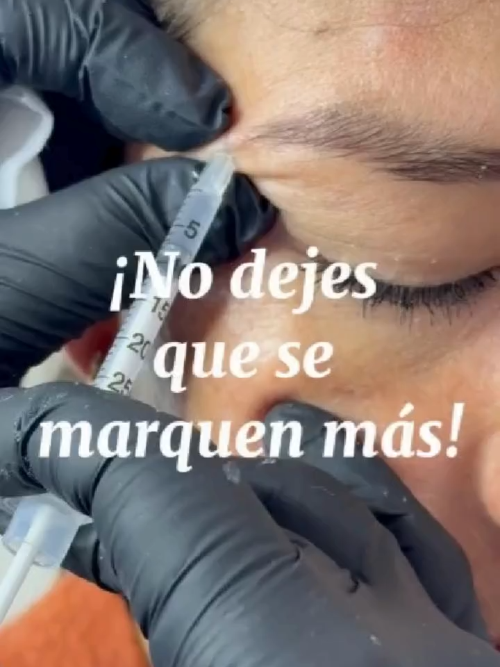 😬 𝐀𝐫𝐫𝐮𝐠𝐚𝐬 𝐪𝐮𝐞 𝐭𝐞 𝐡𝐚𝐜𝐞𝐧 𝐥𝐮𝐜𝐢𝐫 𝐦𝐚𝐲𝐨𝐫 ✅ Atenúa arrugas y líneas de expresión.  ✅ Resultados visibles en pocos días.  ✅ Procedimiento rápido y sin cirugías.  ✅ Aspecto natural, sin perder gestos.  ✅ Previene la aparición de nuevas arrugas. 📣 Di adiós a las líneas de expresión con Botox, el tratamiento rápido, seguro y efectivo para hombres y mujeres que quieren verse y sentirse más jóvenes. 💬 Agenda tu cita y dale a tu rostro el rejuvenecimiento que merece.. 📍 Atendemos en Calle Ampatacocha 301B - Yanahuara  📲 Agenda tu cita al 932 407 470