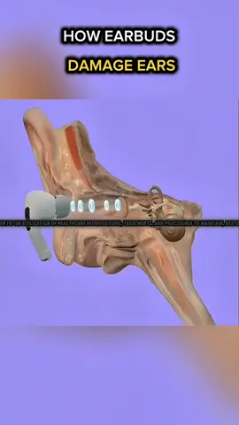 How Earbuds Damage Your Ears? #earbuds #ear #eardamage #eardamagewarning #tinnitus 