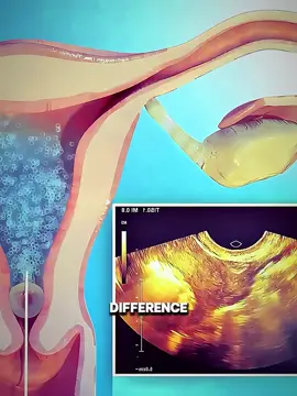 Tubal Clearing VS IVF (Medical Animation 3D) #Tubal #ivfexplained #fertilitytreatment #InfertilityAwareness #reproductivehealthcare #fertility #womenshealth #pregnancyjourney #conceivenaturally #fertilityeducation #HealthAwareness #babyhope #tryingtoconceive #3dmedicalanimation #medical3danimation 