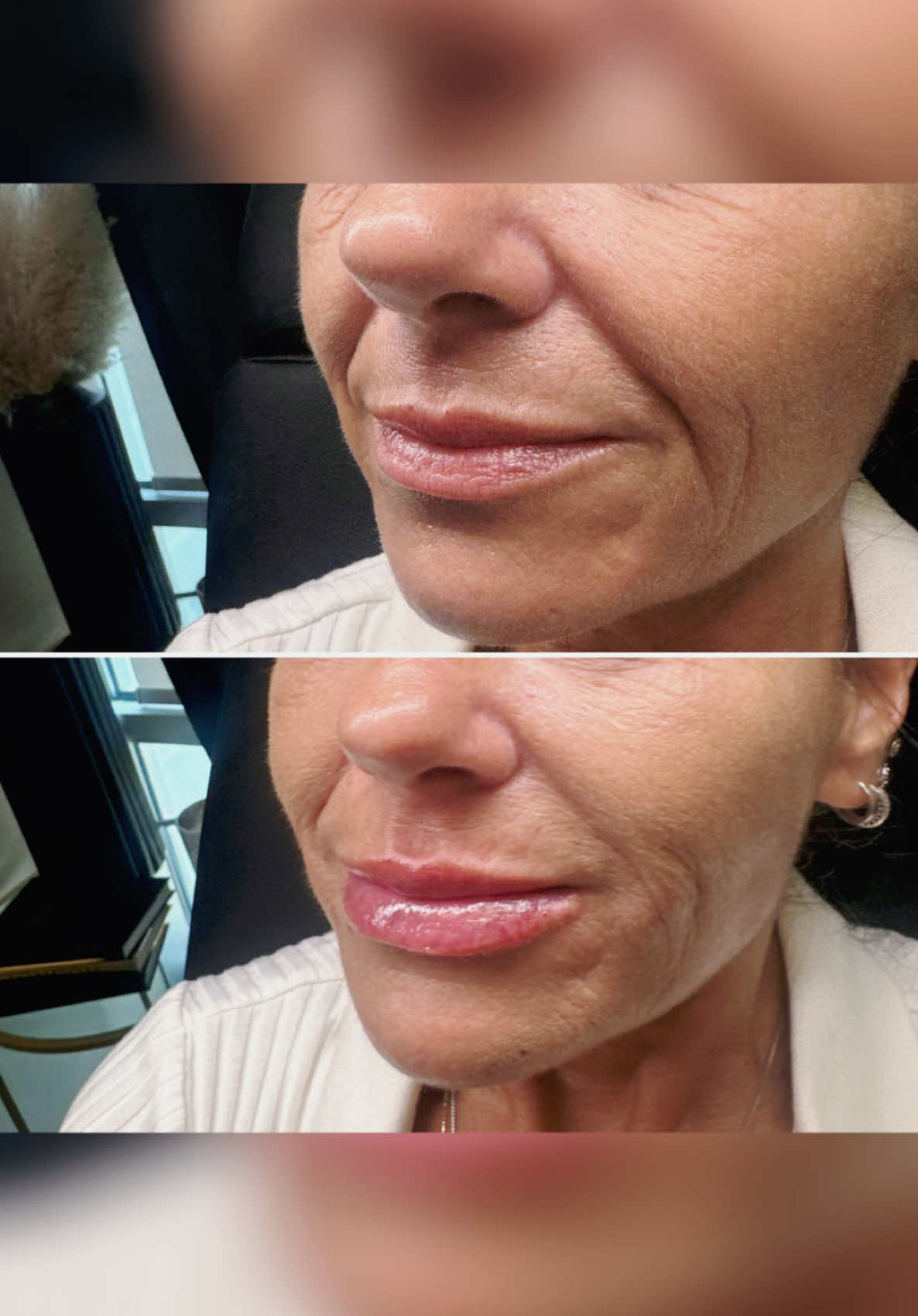 #foryoupage #fyp #trend #StudioSevynAesthetics #lipfiller