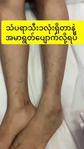 #အမာရွတ်ပျောက်အသားဖြူscrub #BQscrub #kyitahr💜 #fpyシ #foryou 