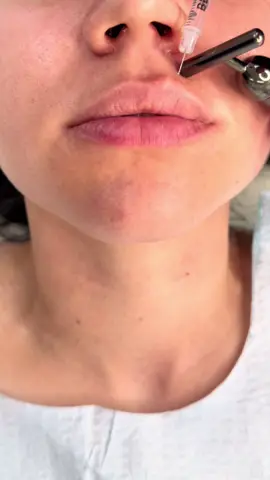 The lip filler diaries 💋 💉 Juvederm Volbella 🫰🏻 Backfill technique into insulin BD syringes for a more precise application. ⛏️ Facial vibrator for distraction  🫙 Numbing cream was applied. . . . #cosmeticclinictj #aestheticmedicine #injectables #lipfiller #juvederm 