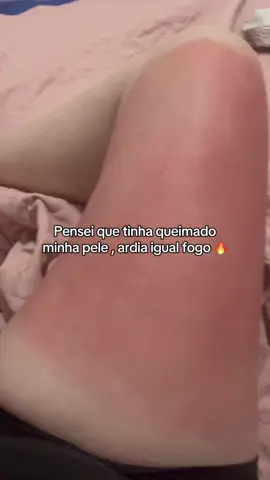 Usei o creme rosa quente do tiktok 2 x por dia 🙌🏻😳#brasil #estria #dicas #estrias #dicasdebeleza 