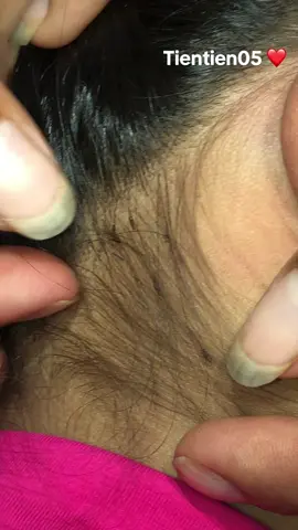 Remove lice #liceo #liceremoval ❤️❤️❤️#omg 🥰🥰🥰🥰