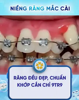 Răng đều đẹp, chuẩn khớp cắn chỉ 9tr9! Thay đổi ngay hôm nay để tự tin tỏa sáng trong mọi khoảnh khắc! #niengrang #niengrangmaccai #xuhuong #tiktok 
