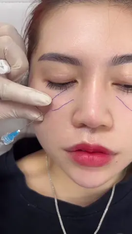 Tiêm làm đầy hốc mắt mỗi bên 0.3cc Cải thiện được vấn đề hốc hác và thiếu sức sống cho đôi mắt của bạn 1 cách nhanh chóng. #ilovetiktok #thẫmmỹ #NhàVyBeauty #filler 