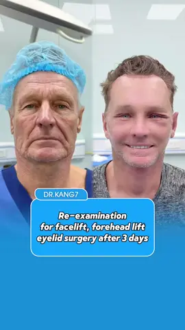 Re-examination for facelift, necklift, foreheadlift, eyelid surgery after 3 days #drkang #kualalumpur #fyp #facelift #facelifttape 