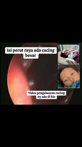 Masih ada cacing besar di perut #rayasukabumi #fakesituation #fyp #fypage #videoviral 