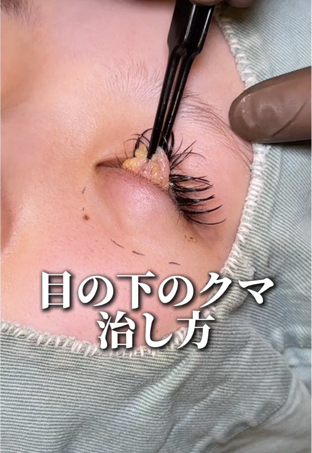 目の下のクマ治し方#クマ治療#クマ取り#整形