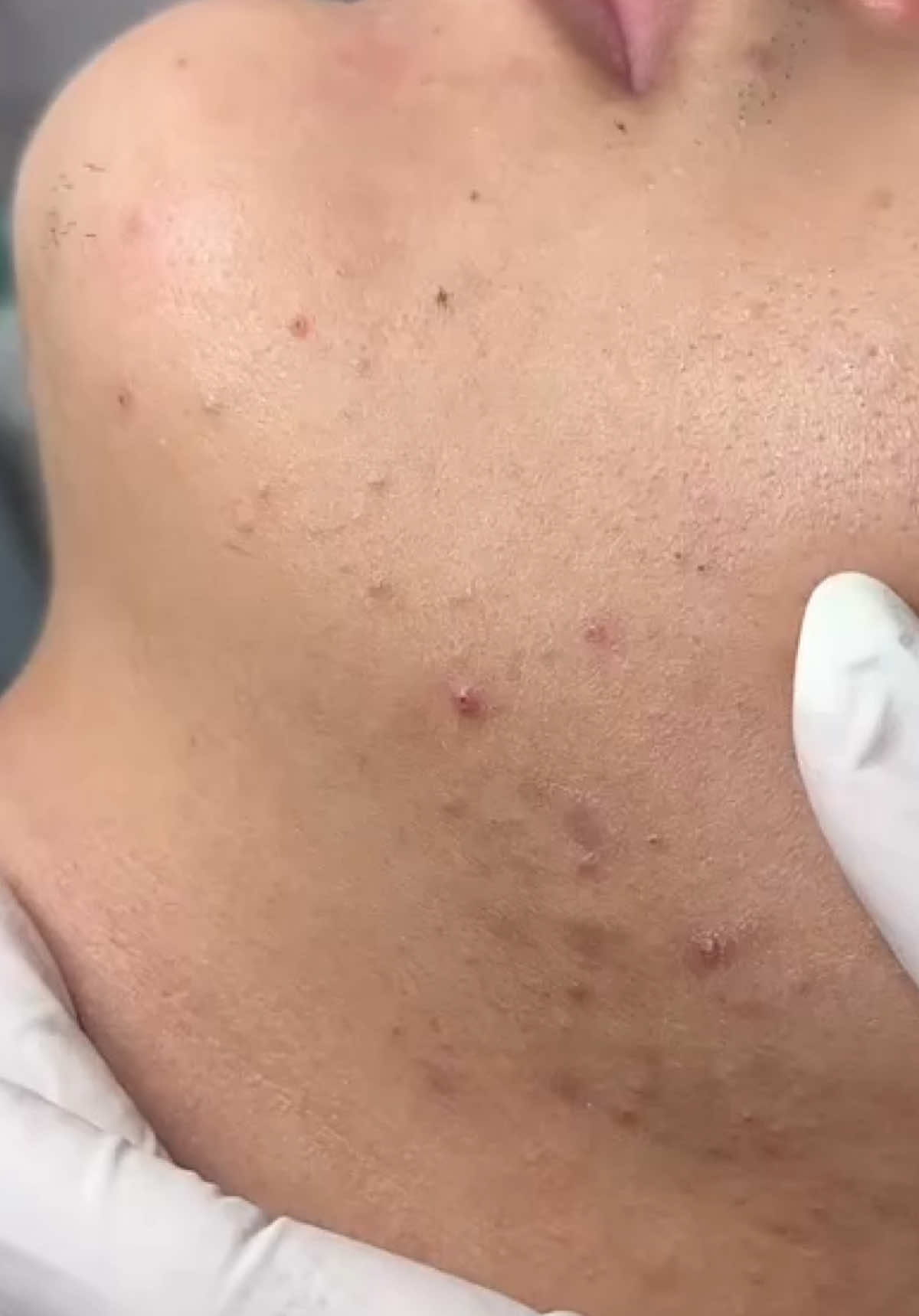 Mụn ẩn dưới da #AcneRemoval #SkincareASMR #OddlySatisfying #nanmun #skincare 