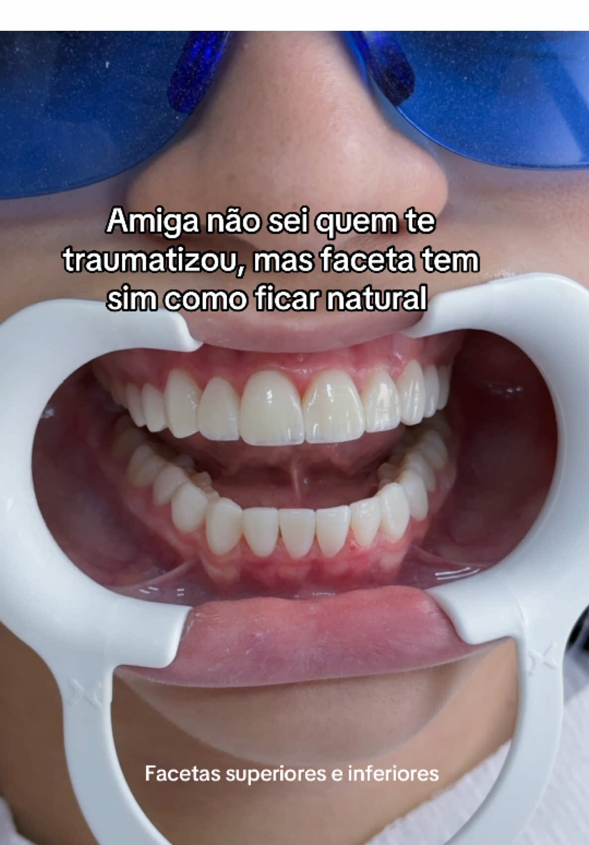 Podemos fazer casos lindos delicados e supernaturais 🤌🏻✨ #carillasdentales #odontologia #dentistaentiktok #compositeveneers #facetas 