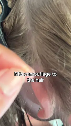 Nits camouflage to the hair l lice removal #fyp #hair #lice #backtoschool 