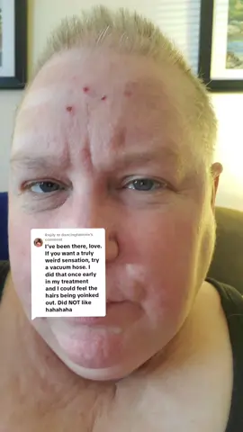 Replying to @dancingtwinnie Weird. #HairLoss #BreastCancer #chemo 