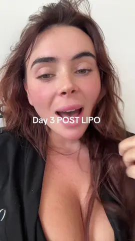 #lipo360 #armlipo #liposuction 