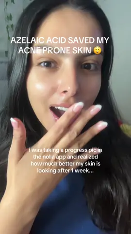 i’m tired of gatekeeping my secrets #skincare #nollaacne #clearskin #derm #skinbarrier #mirrorskin #acnesolution #face #skincarebundle #skincareproductsthatwork 