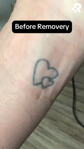 Tattoo Removal Results😲 With over 1.8 million successful treatments under our belt, we are the #1 choice for tattoo removal. Click the link in our bio to find a studio and schedule your FREE consultation today!🔗 #removery #tattooremoval #lasertattooremoval #tattoo #tattoos #fading #tattoofading #fadingtattoos #tattoocoverup #removetattoos #ustattooremoval #australiatattooremoval #canadatattooremoval