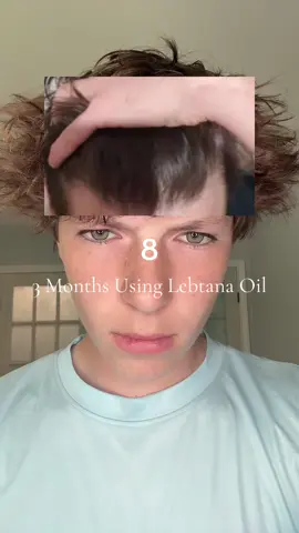 Literally the only thing that worked for me #hairgrowth #mens #hairline #works #viral 
