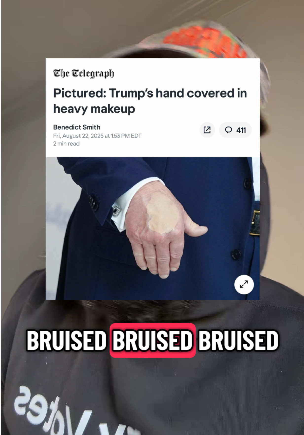 Donald Trump uses makeup to hide bruises on the back of his hands…what’s goin on? #fyp 