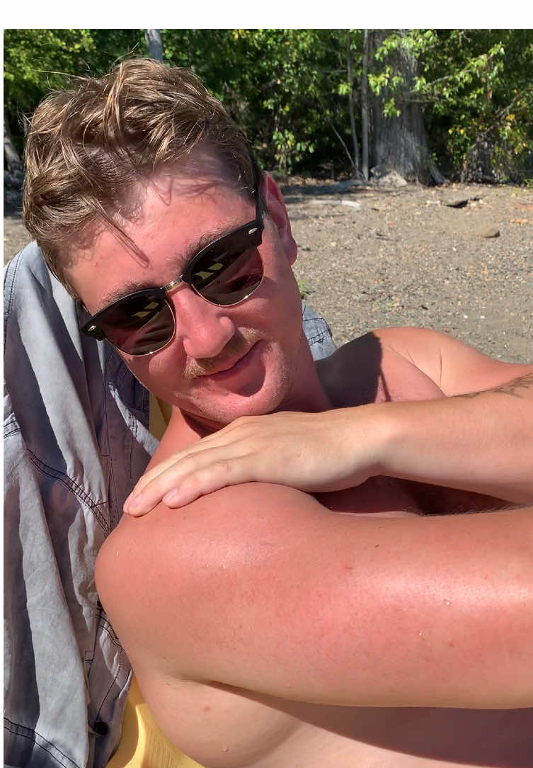 Brother so burnt. he needs aloe