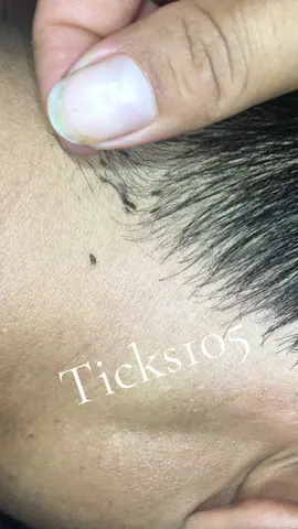 Remove lice #😭😭😭 #😱😱😱omg #liceremoval #🥶🥶🥶 #like 