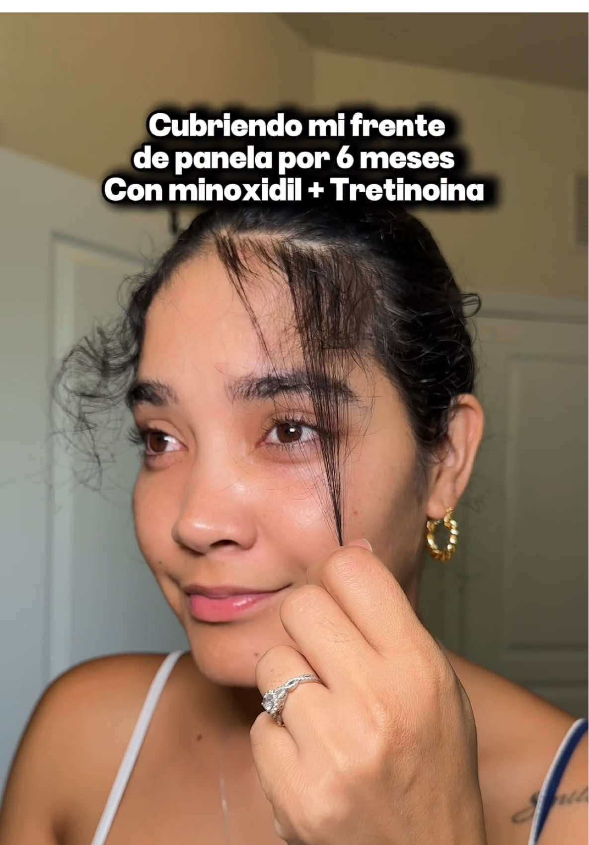✨ ¿Quieres recuperar tu línea de cabello y frenar la caída? ✨ En este video te muestro los resultados reales en 6 meses usando Minoxidil + Tretinoína, una combinación dermatológica que potencia la absorción y acelera el crecimiento capilar. Ideal para quienes sufren de entradas, caída excesiva o debilitamiento del cabello.#creatorsearchinsights #tretinoin #minoxidil #minoxidilresult #acnetreatment 