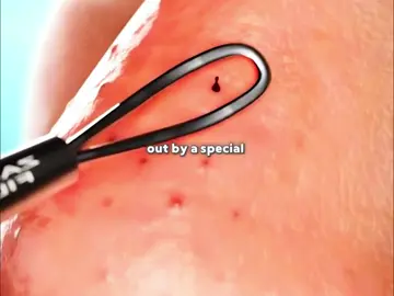 Blackhead remover #blackhead #skincaretips #fyp 