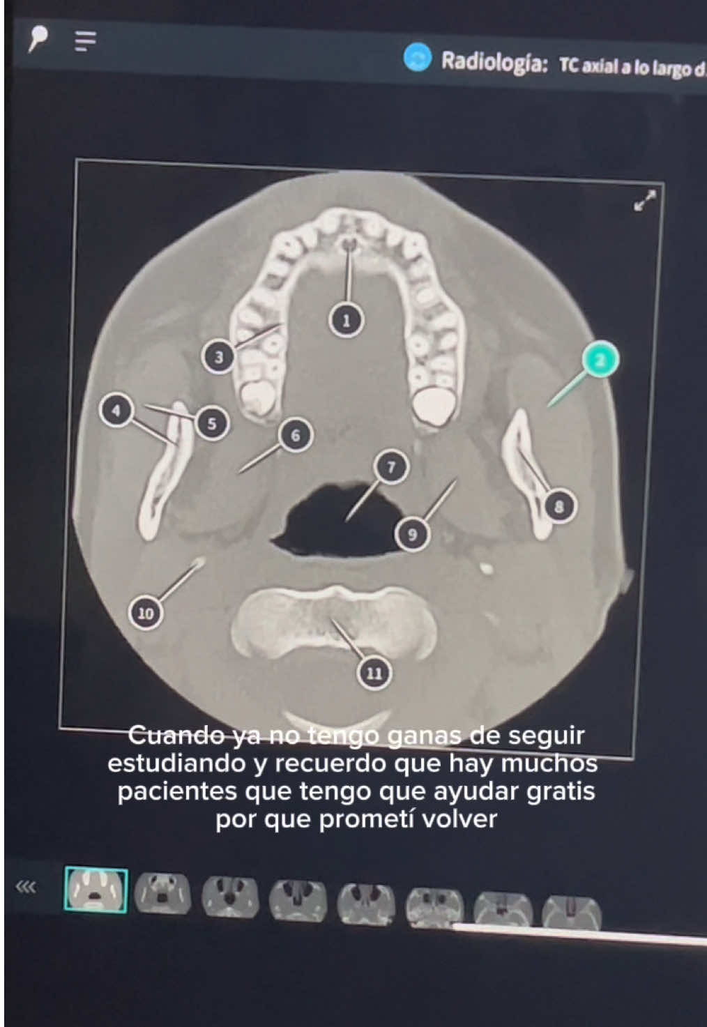 Algun día nos alcanzara para regalar tratamientos y cirugías🦷🤝🏻 #enare #cirugiamaxilofiacial #HastaSerMaxilo #altruismo #anatomiahumana 