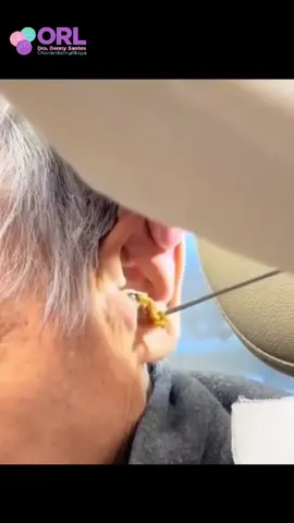 👂 El tapón de cerumen puede causar molestia, disminución de la audición 🎧 e incluso mareos 🤯. ¡Pero cuidado! 🚫 No intentes retirarlo en casa, ya que podrías lastimar tu oído. La forma más segura es acudir a un profesional 👩‍⚕️👨‍⚕️, quien lo extrae de manera adecuada y sin riesgos. Dale a tus oídos el cuidado que merecen 💙. #SaludAuditiva #CuidadoDeLosOídos #Otorrinolaringología #Prevención #Bienestar