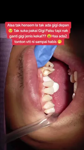 Semua orang dh beralih Ke FRC , Ganti secara kekal, Konfident pun makin naik bila ada Gigi nk senyum panjang2 orang xperasan pon da hilang Gigi sebelum ni,so anda bila lagi ?😍 #Frc #fyp #klinikpergigianawadent #klinikgigikelantan #standwithpalestine 