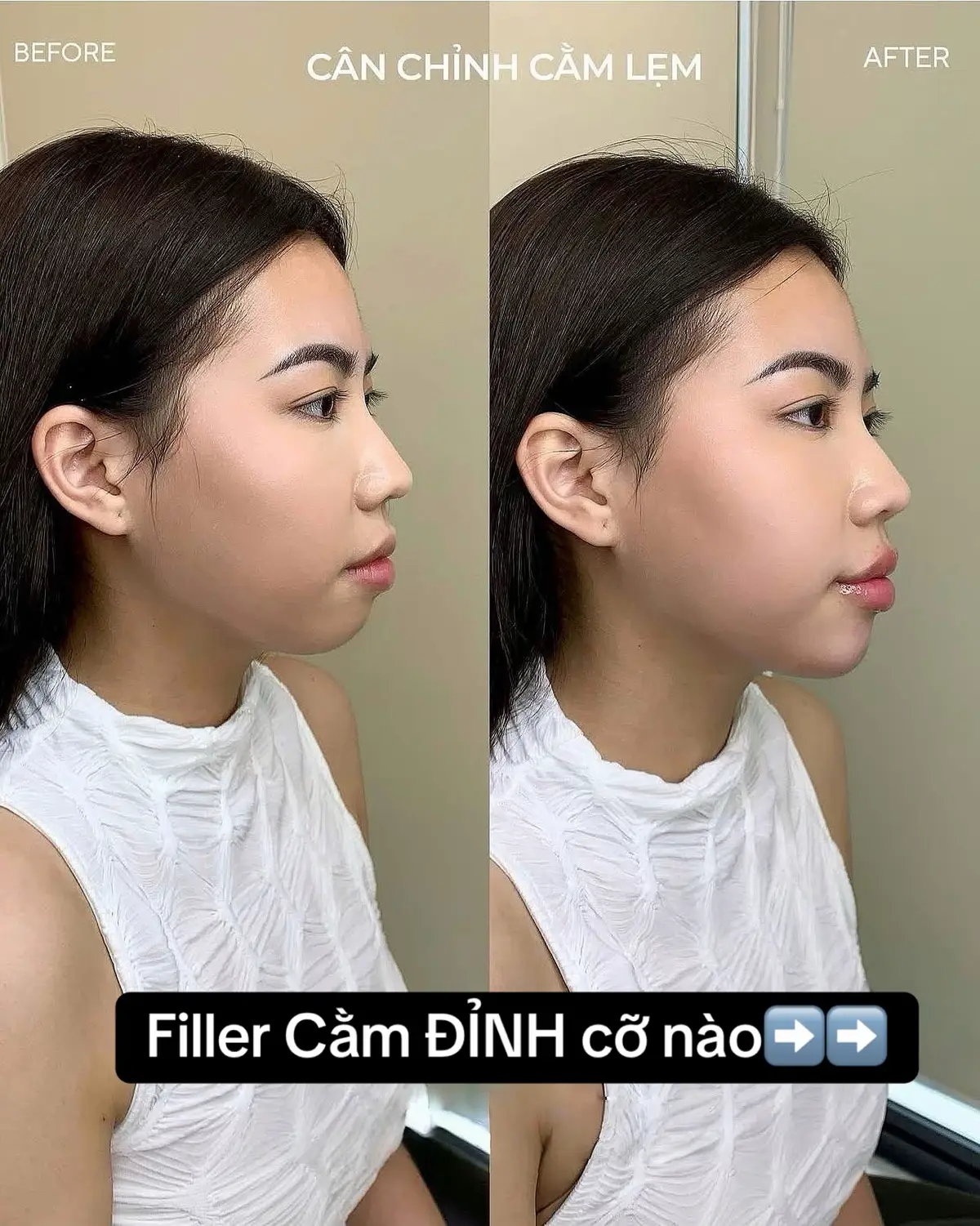 Nếu cằm ngắn miệng hô thì chỉ 15’ 1-3cc cả cằm và viền cằm là thay đổi rõ nét#MinHynBeauty #tiemfillertanbinh #tiemcam #lamdep 