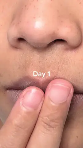 7 days of lip care 👄✨ My lips went from dull & pigmented ➝ brighter, smoother, and soft! This Retinal formula is a total game changer 💕 #KSECRETGlowChallenge @KSECRET GLOBAL #KSECRET #Seoul1988 #pigmentationcare 