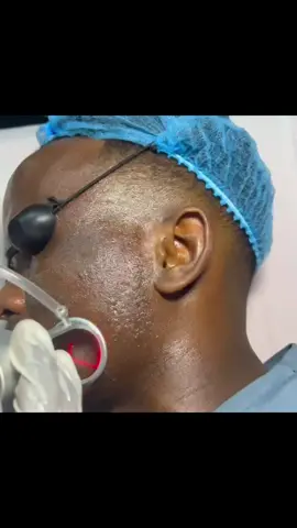 Macamiil KAALIYE DERMATOLOGY waxey idin kentay co2 lesar kaaso ka baabi inayo dhaawacyada maqaarka dulduleelada wajiga haaraha miinta honqorta                     Kala xiriir TELL +252617247499.           Xaruntena waxey kutaala suuqbacaad RUGSAN MALL                #kaaliyedermotolgy1 #dermatologist #co2laser #co2fractional_laser #mogadishu #somalitiktok #co2laserskinresurfacing  