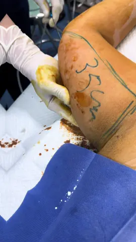 Liposuction arm👨🏻‍⚕️ Clinic VietNam🇻🇳 #liposuction #rhinoplasty #facelift #jakarta #indonesia 
