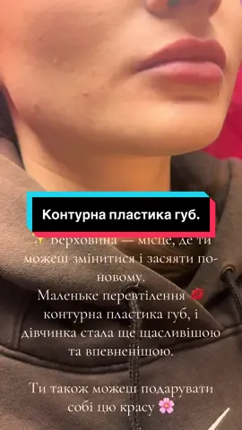 ##КонтурнаПластикаГуб #ЩасливаТаКрасива #перевтілення_до_та_після #рекомендации 