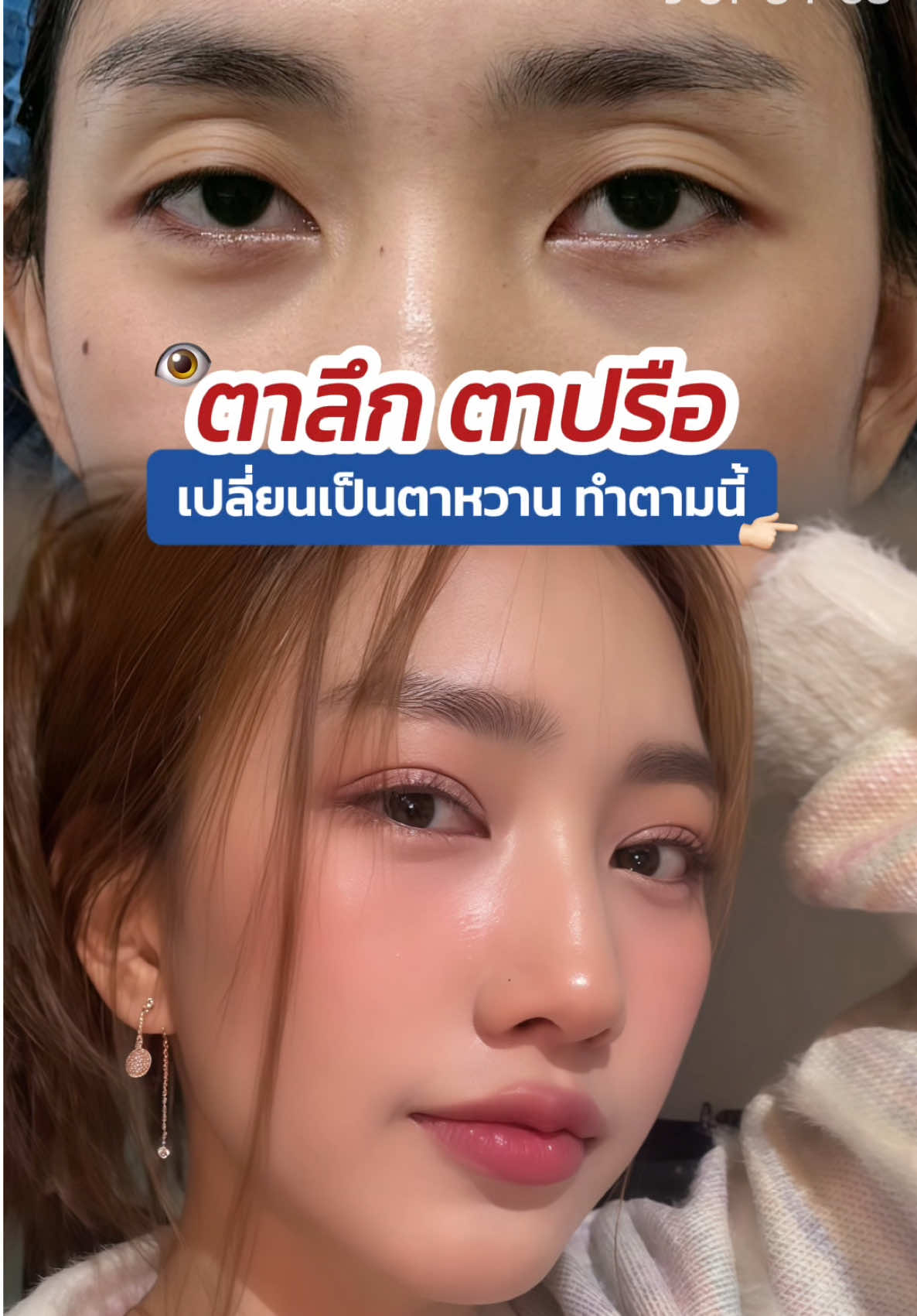 ตาลึก ตาปรือ เปลี่ยนเป็นตาหวานได้ 💖เพราะทำสิ่งนี้ ‼️ #รีวิวตาสองชั้น #skyclinic #จักษุแพทย์ #สกายคลินิก #ทีมแพทย์หมอสกาย 