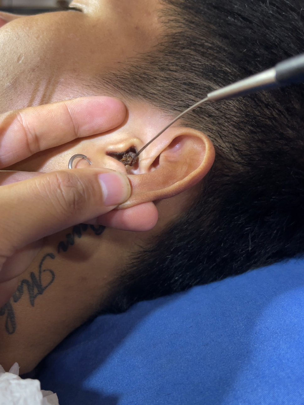 #ear #removal #usa #cleaning #asmr 