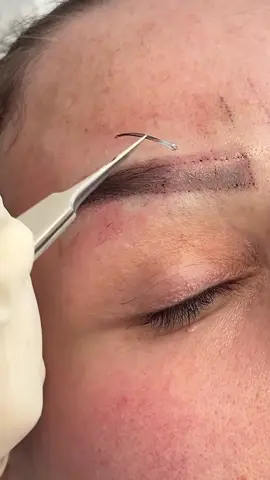 #eyebrows #transplante #istanbul🇹🇷 #eyebrows #transplante #📩 #eyebrows #transplante #istanbul🇹🇷 #eyebrows #transplante #пересадкабровей 
