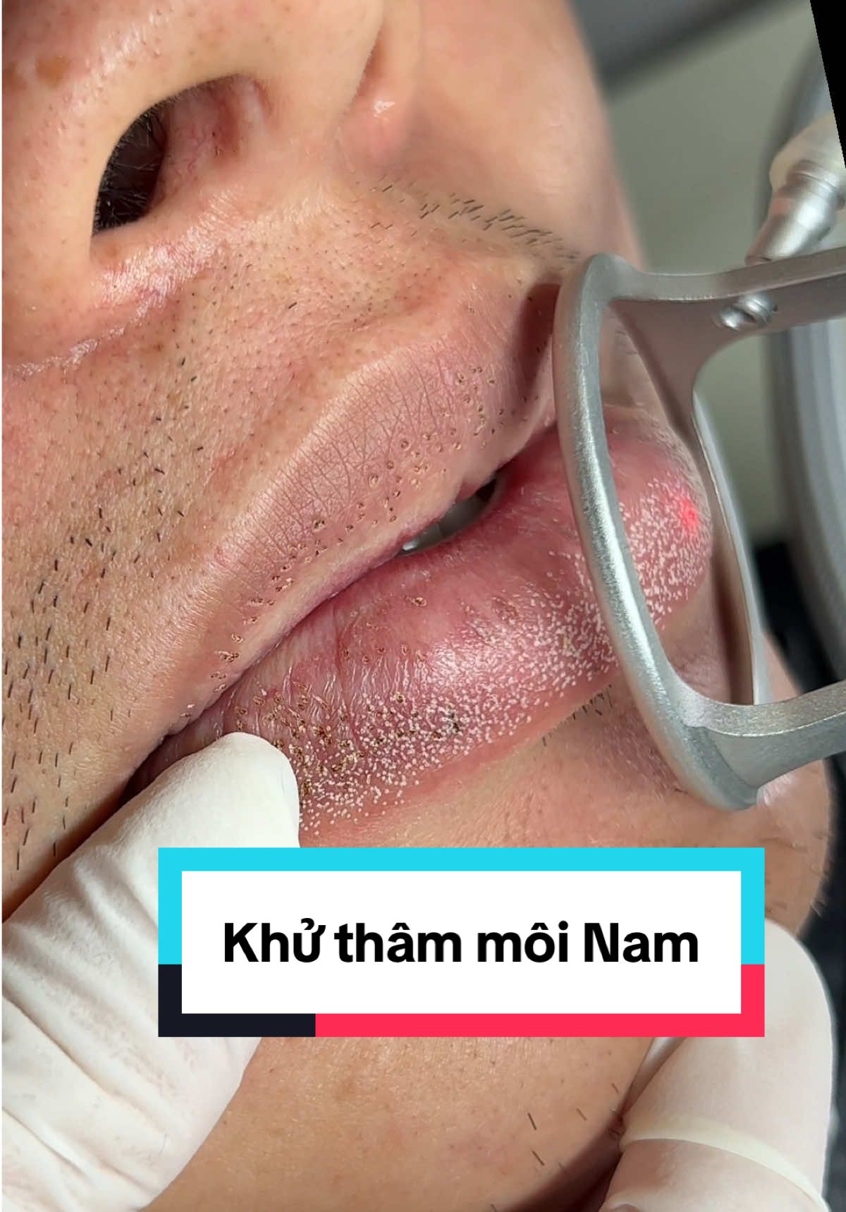 Phương pháp khử thâm môi được các a nam ưa chuộng 🥰 #laserco2fractional #khuthammoi #khuthammoinam #lasermoi #khuthammoi 