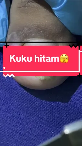 Kuku hitam dibawah??🧐🧐#cantengan #doktercantengan #waduhwaduh #pengobatancantengan #podiatrist 