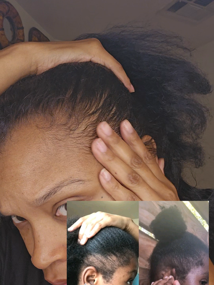 hair growth stimulator ✅️