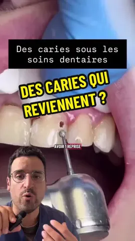 🦷 Carie sous un soin : invisible… et pourtant bien réelle ? 🔍 Qu’appelle-t-on une « reprise de carie » ? On parle de carie secondaire quand une lésion réapparaît au bord d’un composite, d’un inlay/onlay ou sous une couronne. La cause habituelle est une micro-fuite au joint (usure, stress occlusal, ciment fatigué) où plaque et sucres s’infiltrent. La carie « résiduelle », elle, désigne une dentine infectée restée par mégarde sous un ancien soin ; avec le temps, elle progresse. ⚠️ Les signes qui doivent alerter – Sensibilité au froid/sucré localisée sur un vieux soin – Aliments qui se coincent entre deux dents restaurées – Liseré brun au collet d’une couronne, gencive qui saigne à ce bord – Mauvaise haleine malgré une bonne hygiène – Parfois… rien : la lésion est souvent silencieuse au début 📸 Comment on la détecte de manière fiable – Radiographies bite-wings : repèrent un liseré sombre sous le joint ou sous une couronne – Transillumination et caméra intra-orale : visualisent fissures et colorations marginales – Sonde douce au bord du joint (sans « accrocher » agressivement pour ne pas créer de défaut) 🛠️ Le traitement pas à pas (objectif : étanchéité et tissu sain) 	1.	Isolement à la digue et dépose du soin/couronne en sécurité 	2.	Nettoyage sélectif : on retire dentine infectée, on conserve dentine affectée dure si nécessaire pour ne pas fragiliser la pulpe 	3.	Désinfection (chlorhexidine), contrôle visuel/optique de l’assise 	4.	Choix de la restauration : – lésion modérée → composite adhésif stratifié – perte cuspidaire → inlay/onlay collé – sous couronne mal adaptée → nouvelle couronne céramo-céramique avec marge polie 	5.	Collage soigneux (mordançage, adhésif multi-couches, photopolymérisation contrôlée) et vérification occlusale 🧪 Pourquoi ça revient parfois – Marges en sous-gingival difficiles à nettoyer – Bruxisme non protégé (micro-fissures du joint) – Bouche sèche, grignotages sucrés/acides répétés – Hygiène interdentaire insuffisante 🪥 Prévenir les récidives (ce qui marche vraiment) – Brosse souple 2×/jour + fil ou brossettes chaque soir – Dentifrice ≥ 1450 ppm fluor ; vernis fluor trimestriel si risque élevé – Limiter les prises sucrées/acides en dehors des repas, rincer à l’eau après – Gouttière nocturne si serrage/grincement – Contrôles et détartrage réguliers ; bite-wings de suivi selon le risque carieux 💡 À retenir Une reprise de carie n’est pas un « échec » inévitable : c’est le signal qu’il faut restaurer l’étanchéité et adapter les habitudes. Repérée tôt et traitée sous digue avec un protocole adhésif rigoureux, la dent retrouve une base saine et durable. #carie #plombage #composite #couronne #radiographie       